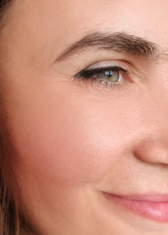 After — Botox for crow's feet at Brookswood Shine Dental
