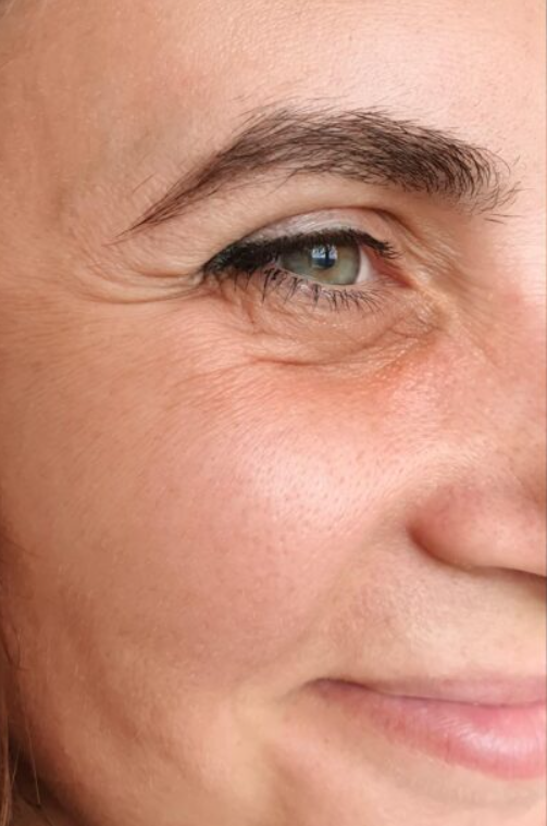 Before — Botox for crow's feet at Brookswood Shine Dental