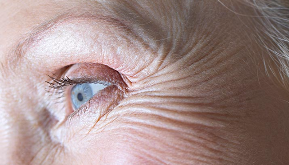 Botox for crow's feet and wrinkle prevention at Brookswood Shine Dental