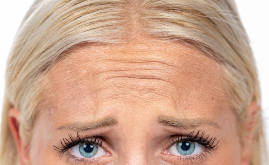 Botox for forehead and frown lines at Brookswood Shine Dental