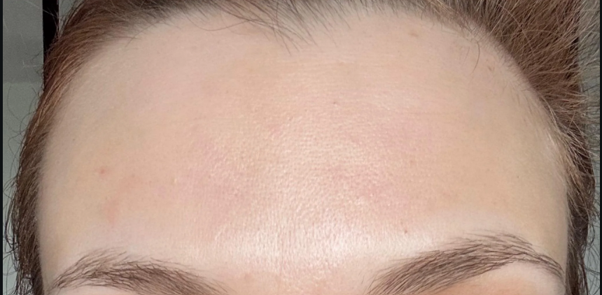 After — Botox for forehead lines at Brookswood Shine Dental