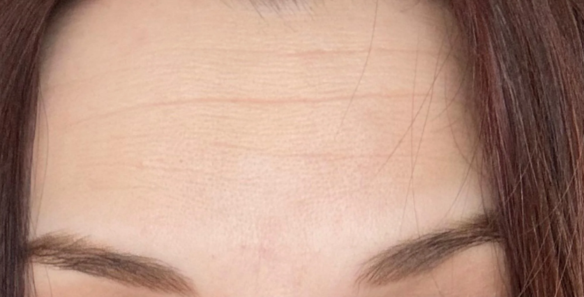 Before — Botox for forehead lines at Brookswood Shine Dental