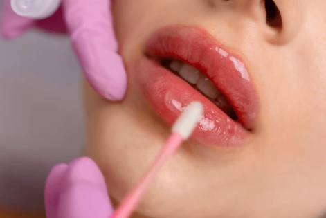 Dermal fillers for lip and cheek volume at Brookswood Shine Dental
