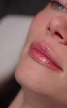 After — dermal fillers for lip enhancement at Brookswood Shine Dental