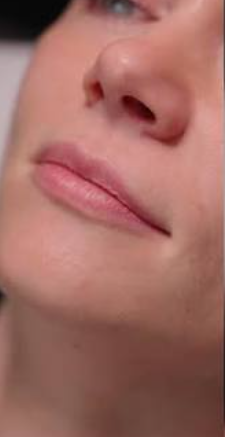 Before — dermal fillers for lip enhancement at Brookswood Shine Dental